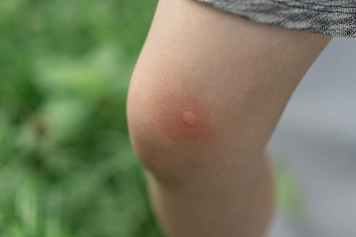 Mückenstich am Knie