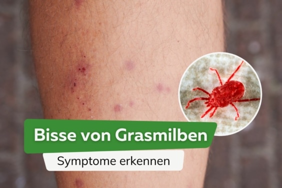 Bisse von Grasmilben: Symptome erkennen